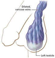 Varicocele