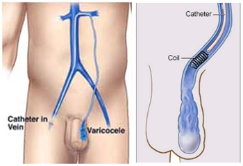 Varicocele